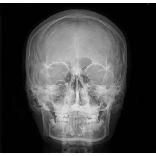 X-Ray Zygomatic Arch-Both